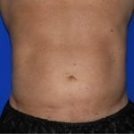 Liposuction Before & After Patient #2247