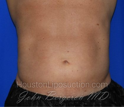 Liposuction Before & After Patient #2247