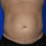 Liposuction Before & After Patient #2247