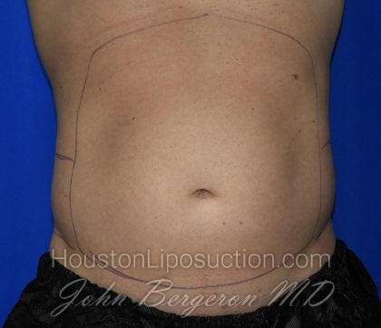 Liposuction Before & After Patient #2247