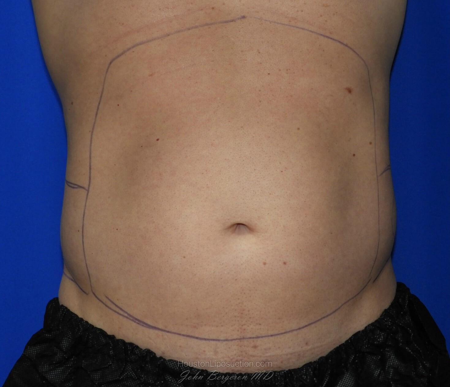 Liposuction Before & After Patient #2247