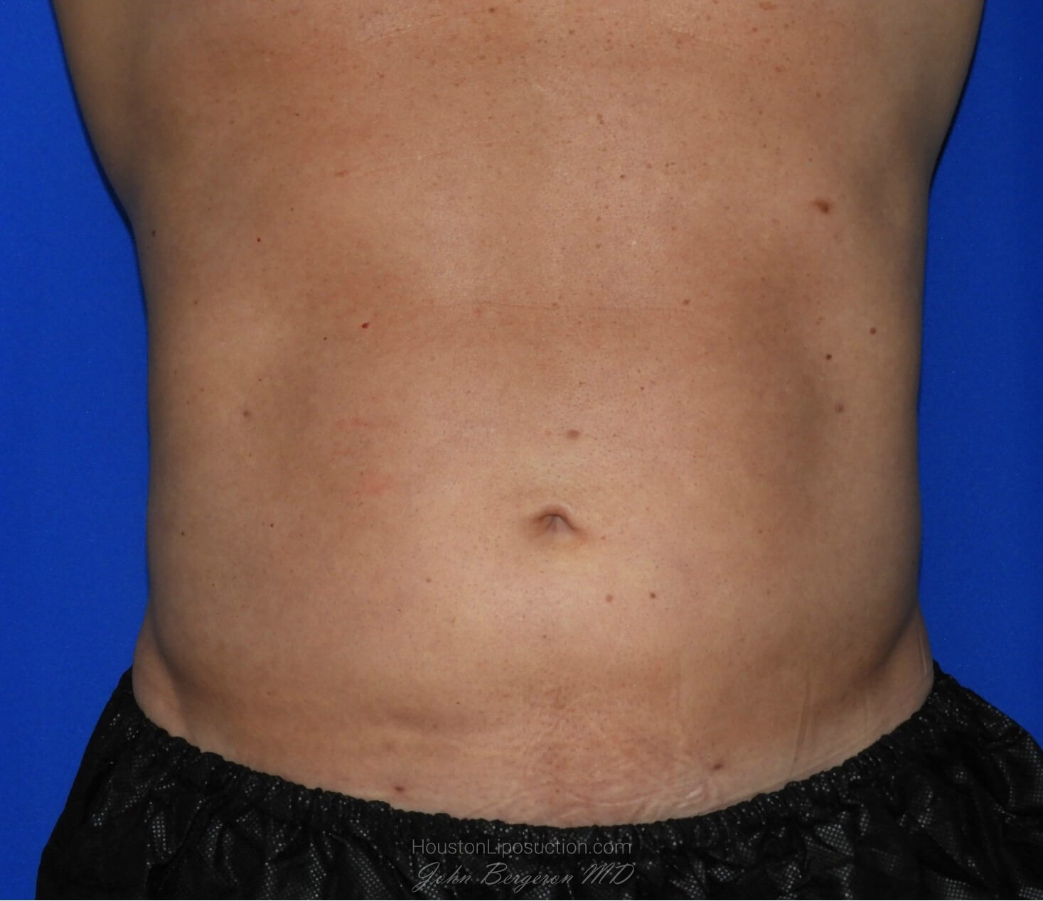 Liposuction Before & After Patient #2247