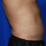 Liposuction Before & After Patient #2247