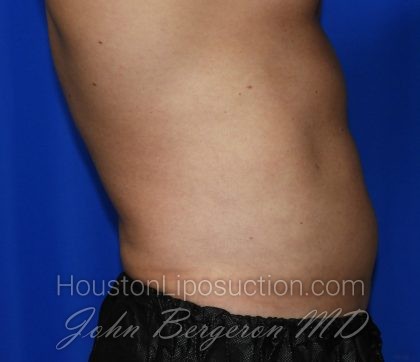 Liposuction Before & After Patient #2247