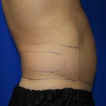 Liposuction Before & After Patient #2247