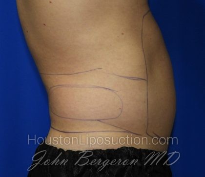 Liposuction Before & After Patient #2247