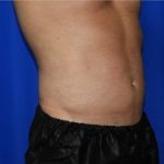 Liposuction Before & After Patient #2247