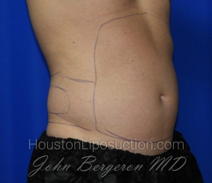 Liposuction Before & After Patient #2247