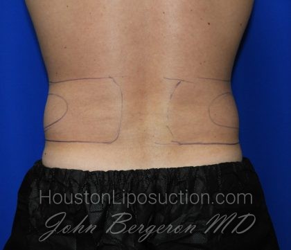 Liposuction Before & After Patient #2247