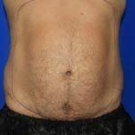 Liposuction Before & After Patient #2315