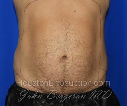 Liposuction Before & After Patient #2315