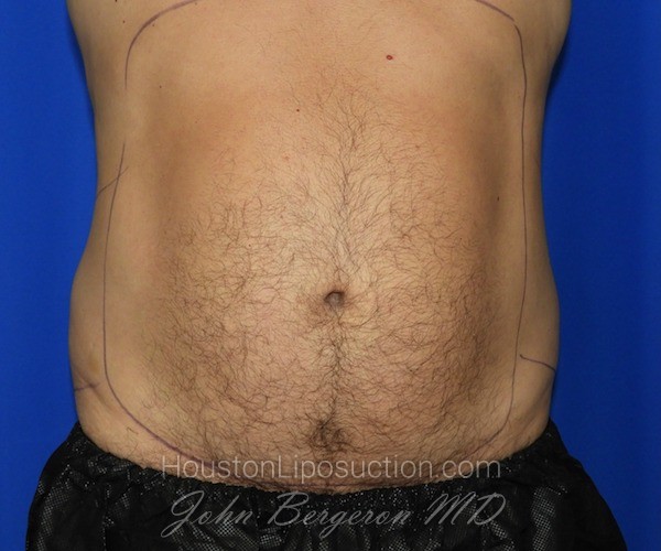 Liposuction Before & After Patient #2315