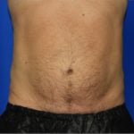 Liposuction Before & After Patient #2315