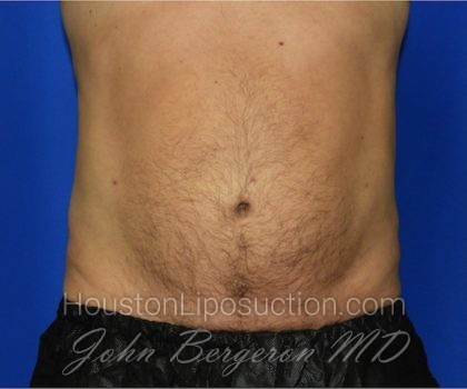 Liposuction Before & After Patient #2315