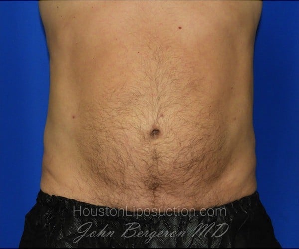 Liposuction Before & After Patient #2315