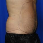 Liposuction Before & After Patient #2315