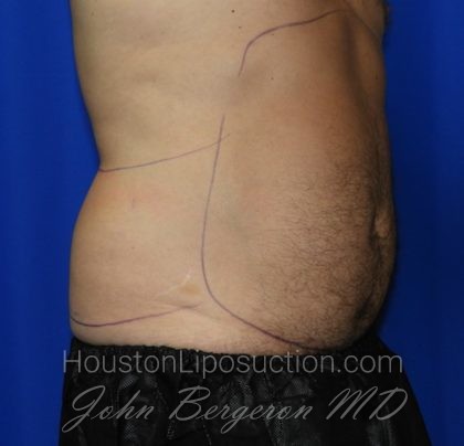 Liposuction Before & After Patient #2315