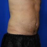 Liposuction Before & After Patient #2315