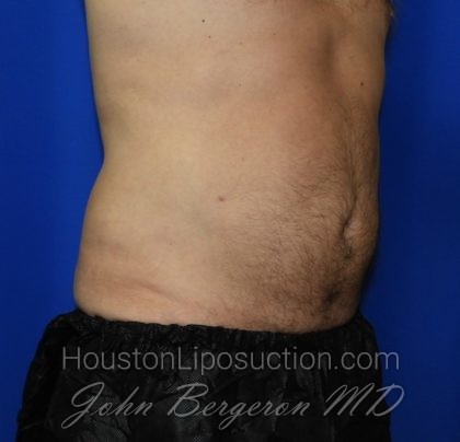 Liposuction Before & After Patient #2315