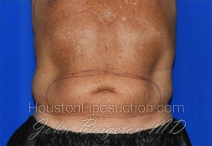 Liposuction Before & After Patient #2332