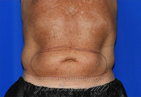 Liposuction Before & After Patient #2332