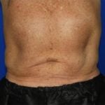 Liposuction Before & After Patient #2332