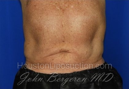 Liposuction Before & After Patient #2332