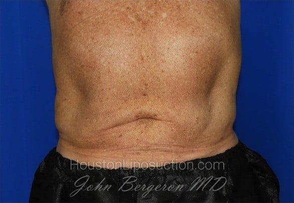 Liposuction Before & After Patient #2332