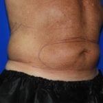 Liposuction Before & After Patient #2332