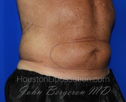 Liposuction Before & After Patient #2332