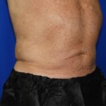 Liposuction Before & After Patient #2332