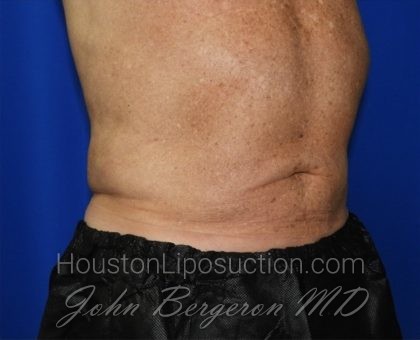 Liposuction Before & After Patient #2332