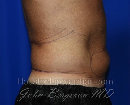 Liposuction Before & After Patient #2332