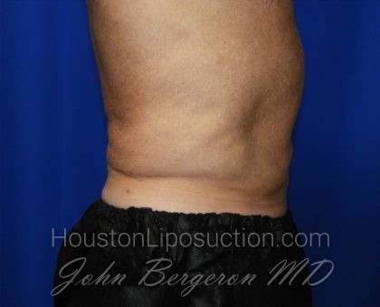 Liposuction Before & After Patient #2332