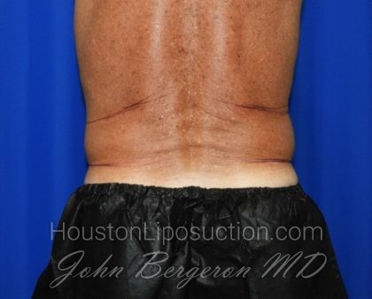 Liposuction Before & After Patient #2332