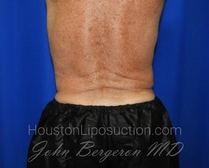 Liposuction Before & After Patient #2332