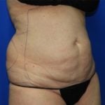 Liposuction Before & After Patient #2327