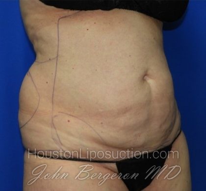 Liposuction Before & After Patient #2327