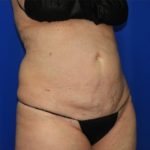 Liposuction Before & After Patient #2327