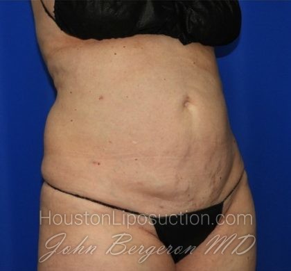 Liposuction Before & After Patient #2327