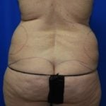 Liposuction Before & After Patient #2327