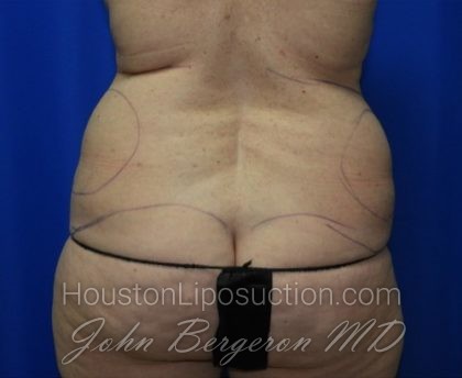 Liposuction Before & After Patient #2327