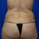 Liposuction Before & After Patient #2327