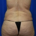 Liposuction Before & After Patient #2327