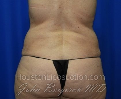 Liposuction Before & After Patient #2327