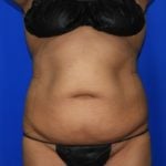 Liposuction Before & After Patient #2362