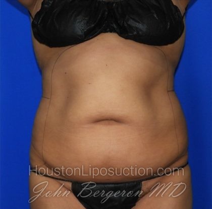 Liposuction Before & After Patient #2362