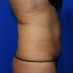 Liposuction Before & After Patient #2362