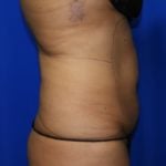 Liposuction Before & After Patient #2362