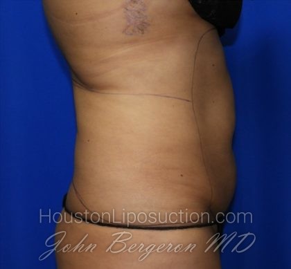 Liposuction Before & After Patient #2362